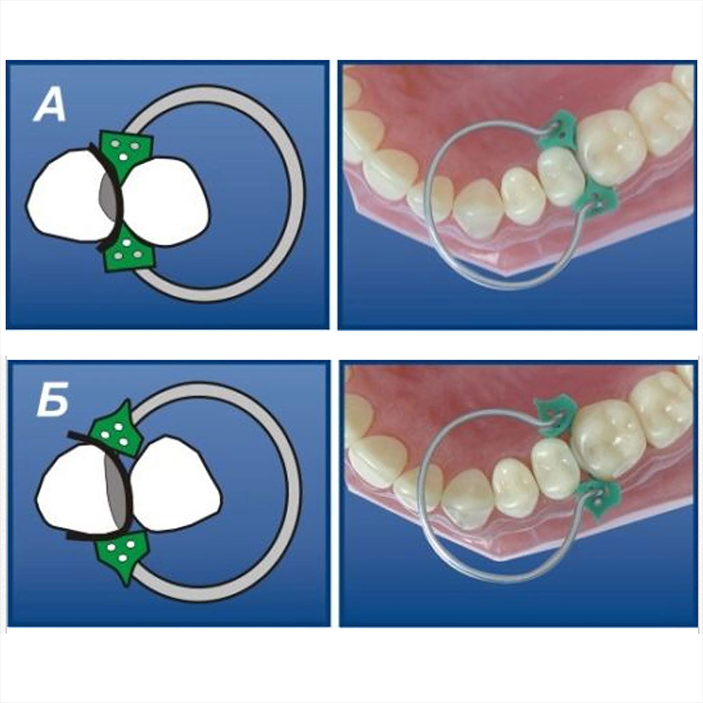 Dental Add On Silicone Wedges 40Pcs/Bag