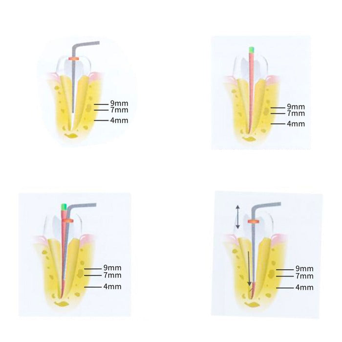 Dental Cordless Gutta Percha Obturation System Endo Heated Pen J1SS 4 Tips-azdentall.com