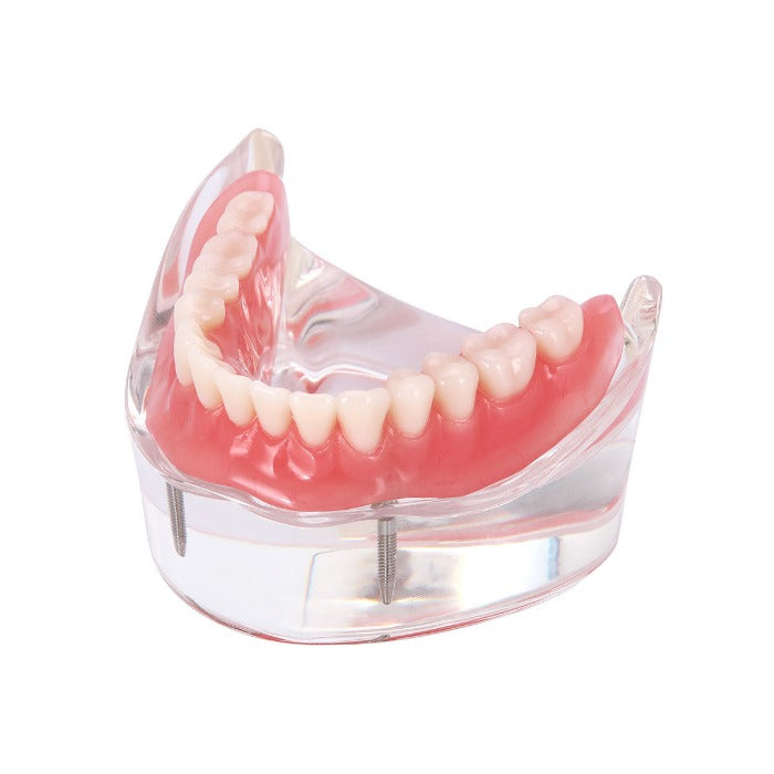 Dental Implant Teeth Model Demo Overdenture Restoration With 2 Implants Lower - azdentall.com