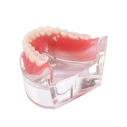 Dental Implant Teeth Model Demo Overdenture Restoration With 2 Implants Lower - azdentall.com