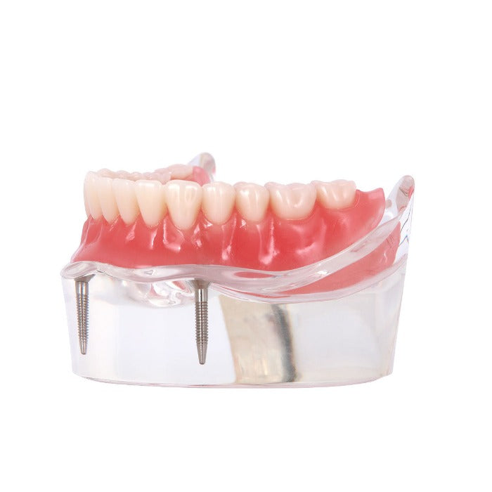 Dental Implant Teeth Model Demo Overdenture Restoration With 2 Implants Lower - azdentall.com