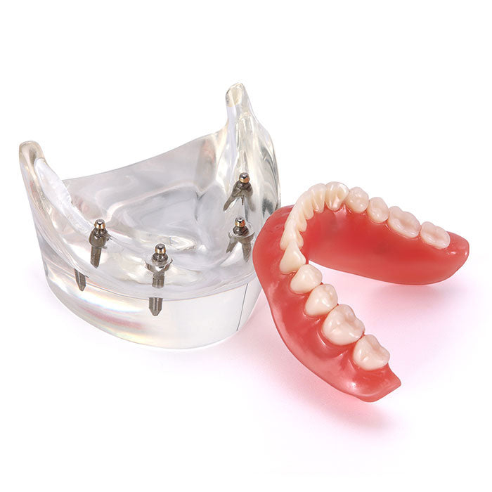 Dental Implant Teeth Model Demo Overdenture Restoration With 4 Implants Lower - azdentall.com