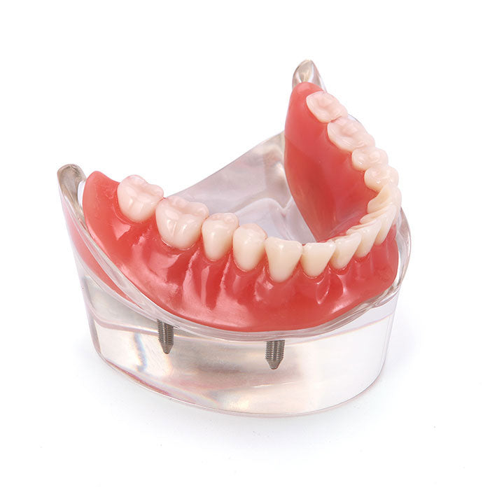 Dental Implant Teeth Model Demo Overdenture Restoration With 4 Implants Lower - azdentall.com