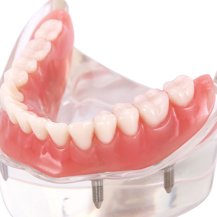 Dental Implant Teeth Model Demo Overdenture Restoration With 4 Implants Lower - azdentall.com